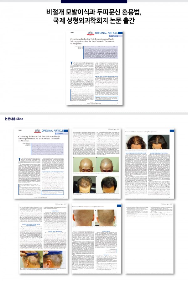 뉴헤어의원 - 비절개 모발이식과 두피문신 혼용법, 국제 성형외과학회지 논문 출간