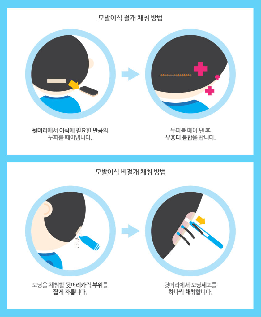 모발이식 절개 비절개 채취방법 차이_뉴헤어의원_inewhair