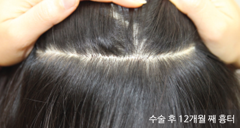 모발이식 절개 수술 후 12개월 흉터_뉴헤어의원_inewhair