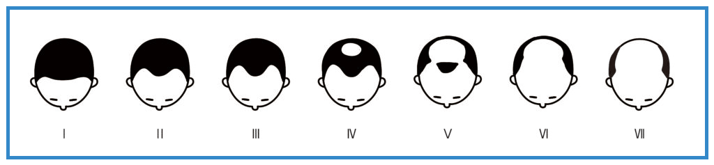 해밀턴 탈모 단계_뉴헤어의원_inewhair