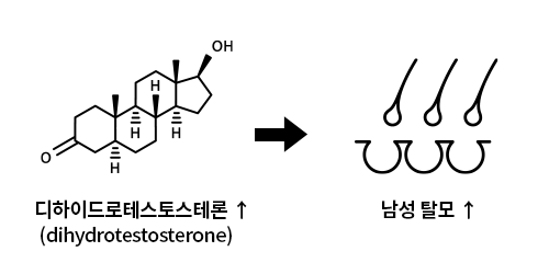 DHT 남성 탈모_뉴헤어모발성형외과_inewhair