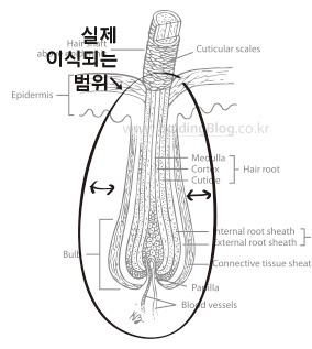 모발이식 슬릿방식