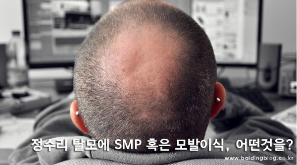 SMP.모발이식