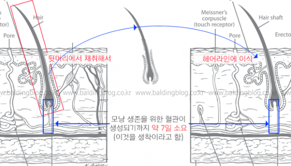 모낭생착