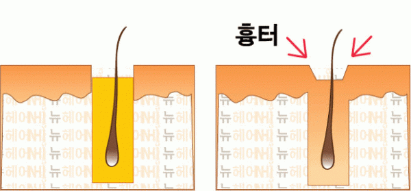 모발이식 흉터