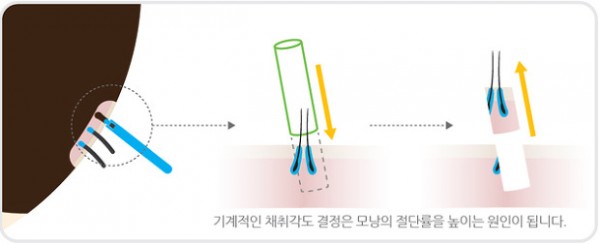 비절개법 모발이식