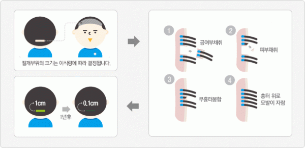 모발이식흉터