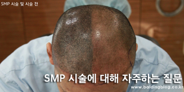 SMP 시술