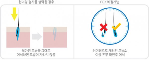 비절개법 모발이식