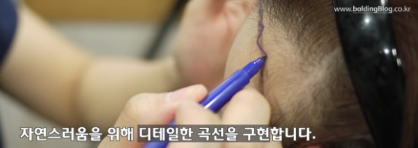 헤어라인교정