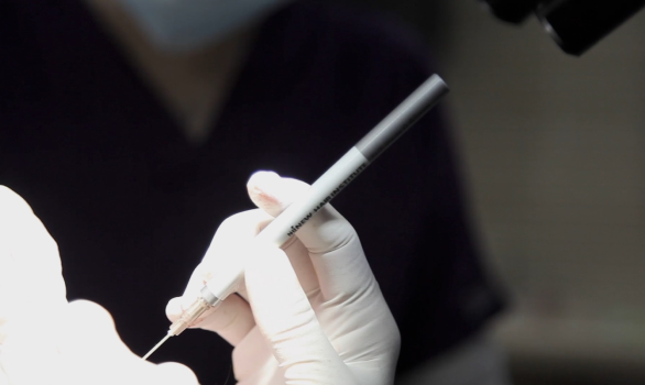 두피 손상이 적은 최소 침습 모발이식