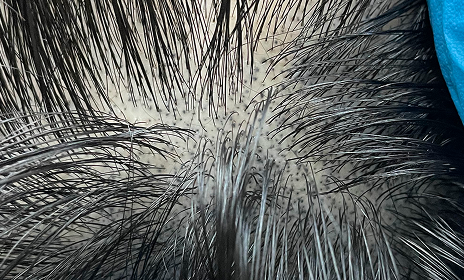 실제 머리카락이 자라난 듯
표현하는 뉴헤어만의 노하우