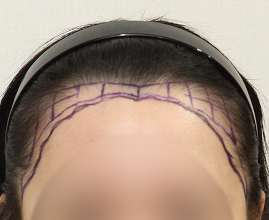 성형외과 의사 선생님이 개인의 비율과 모양을 분석하여 맞춤형 디자인합니다