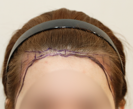 성형외과 의사 선생님이 개인의 비율과 모양을 분석하여 맞춤형 디자인합니다