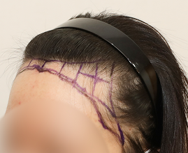 성형외과 의사 선생님이 개인의 비율과 모양을 분석하여 맞춤형 디자인합니다