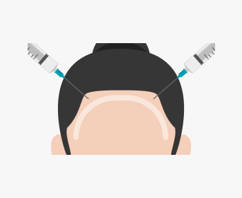 절개 헤어라인교정