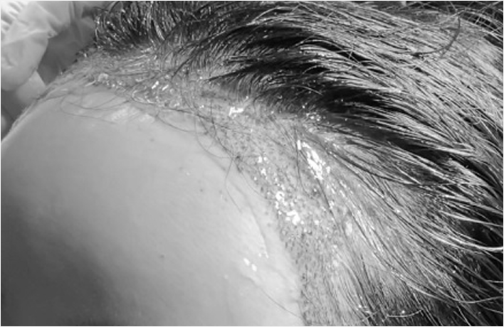 헤어라인 교정 후 EGF성분의 젤과 생착스프레이를 사용하여 흉터 조직이 빠르고
깨끗하게 아물도록 도와주고 붉은기를 빠르게 해소해 일상생활 복귀가 빠릅니다.