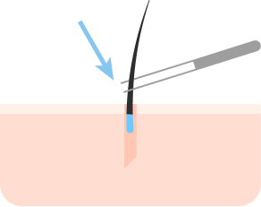 모공에 이식모낭 삽입