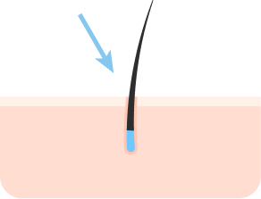 흉터 적게 깨끗한 이식결과