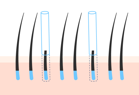 사전 컷팅 비절개