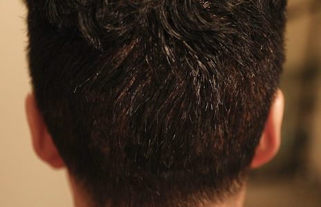 수술 후 다음날 (샴푸 후)