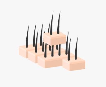 절개 헤어라인교정