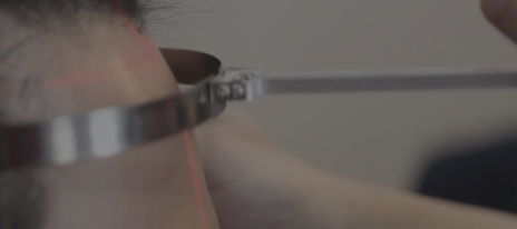 모발이식(헤어라인 교정)