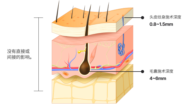 두피 모낭 시술의 깊이